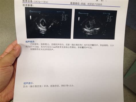 怀孕多久可以做b超能看出来