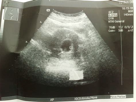 胎儿六个月胎心正常吗