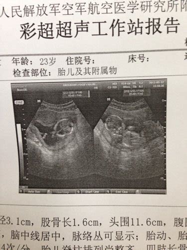 男孩胎囊图片 形状