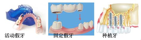 为什么假牙吃饭没味道