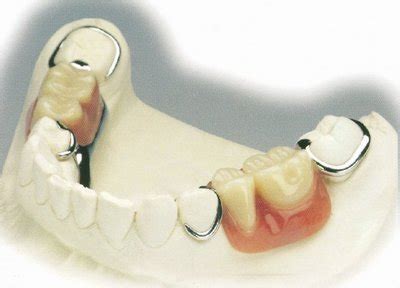 假牙上颚吸盘怎么修