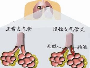 老人支气管炎哮喘用药