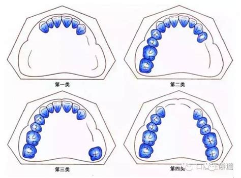 可摘局部义齿取模图