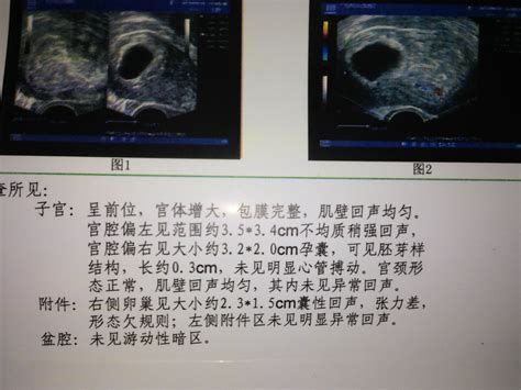 怀孕4周hcg4000正常吗