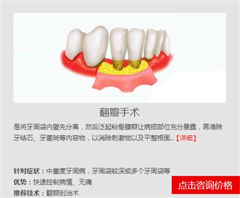 宁波种牙纳入医保项目吗