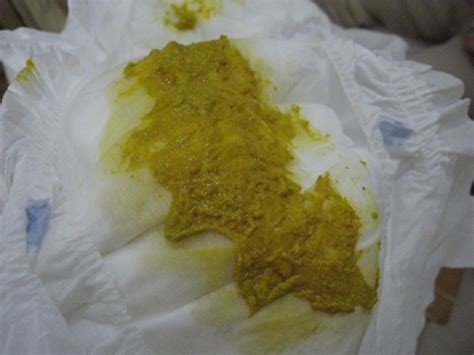 便秘拉绿屎是怎么回事