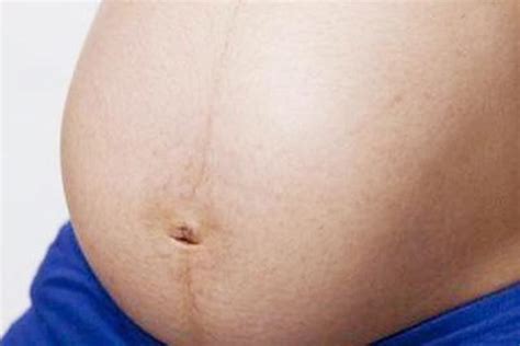 怀孕后肚子有条黑线是什么