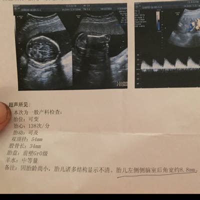 怀孕11周胎儿b超图结果图