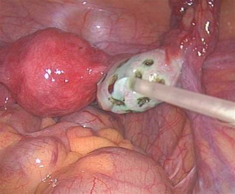 左卵巢旁囊性结构宫外孕