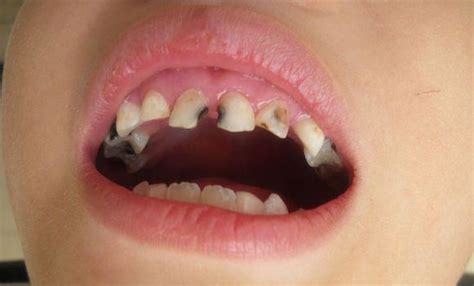 牙龈流血是怎么回事