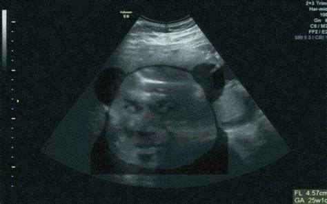 怀孕一个月b超图像