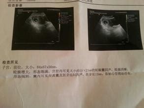 孕囊看生男生女准吗