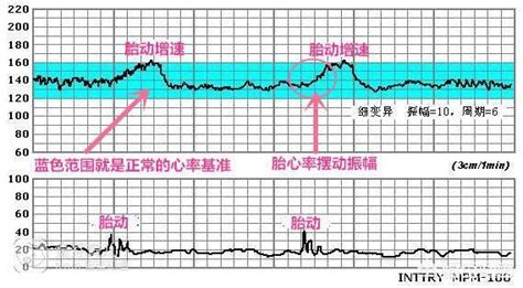 nt1.1胎心150