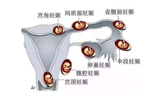 输卵管造影后容易怀孕