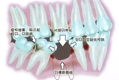 儿童牙齿根尖闭合时间