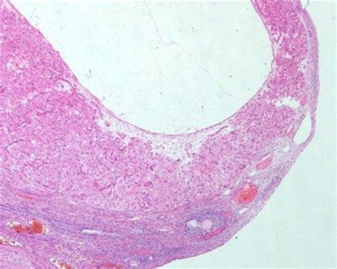 卵泡与囊肿有什么区别