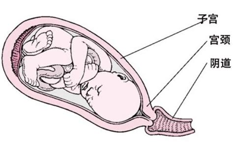 胎儿30周臀位怎么纠正