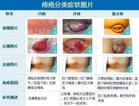 盐水盆浴能缓解痔疮吗