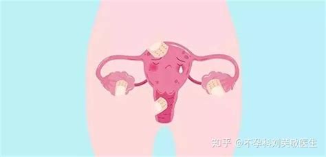 引起子宫内膜异位症的原因