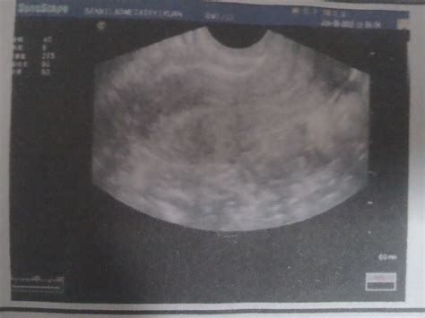 宫外孕一定要输卵管切除吗