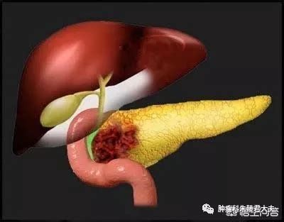 堵奶容易诱发乳腺癌吗