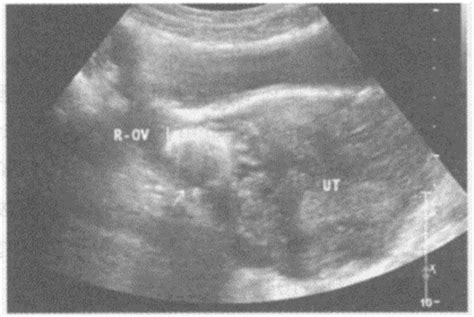 双胞胎卵黄囊一般孕几周可见