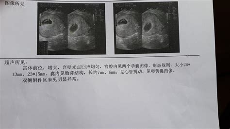 怀孕五个月胎儿胎心停止
