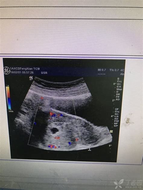 怀孕35天孕囊偏左侧
