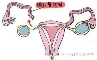 双侧输卵管通而不畅影响怀孕吗