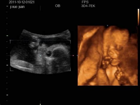 孕16周看不见胎儿膀胱