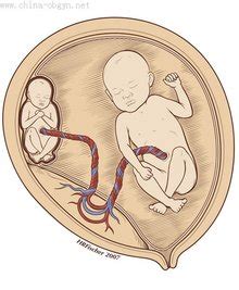 双胎输血综合征的原因有哪些