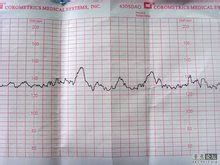 如何看胎心监护上面的宫缩