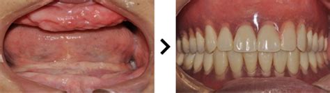 半口假牙吸附安装方法