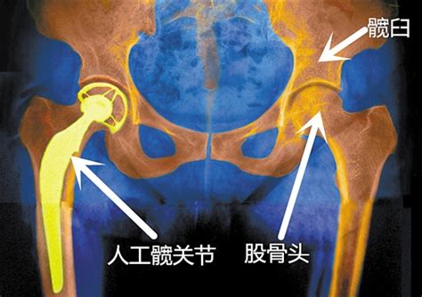 髋骨与股骨