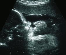 五个月胎儿的位置