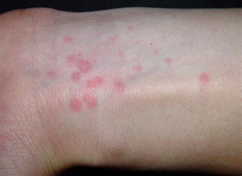 孩子湿疹什么症状