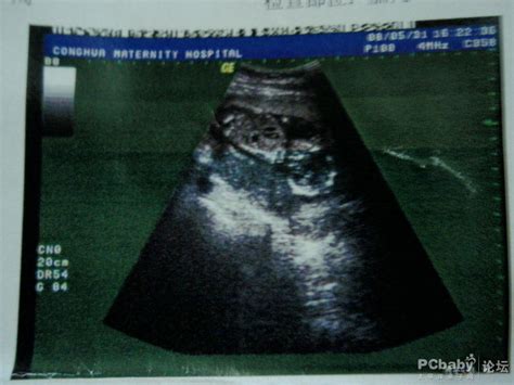 怀孕23周孩子双顶径