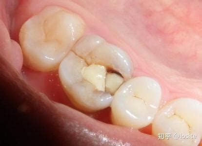 假牙断了怎么修复