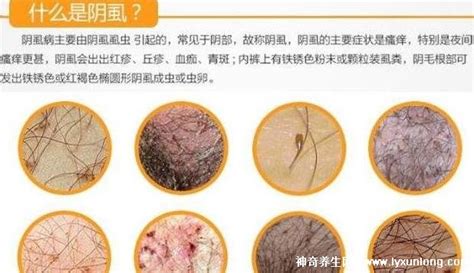 除掉陰虱的方法?