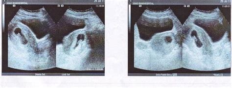 怀孕33天没有看见胎囊