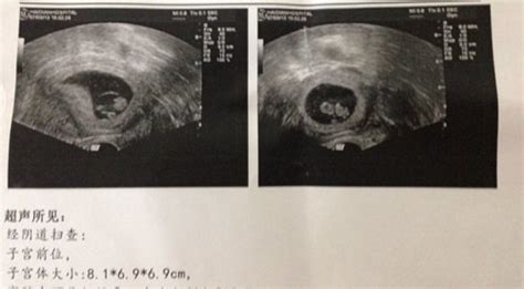 孕6周单胎有可能变双胞胎吗