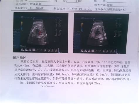 胎儿心脏0.16cm的缺口