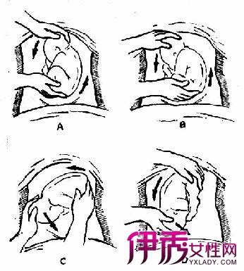 胎儿臀位分娩怎么做