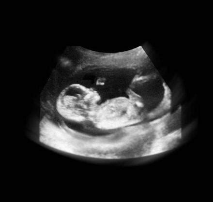 孕17周胎儿缺氧症状