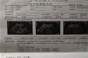 孕11周才发现胎芽胎心