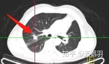 肺部条索灶与结节区别