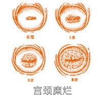 宫颈糜烂3度的危害有哪些