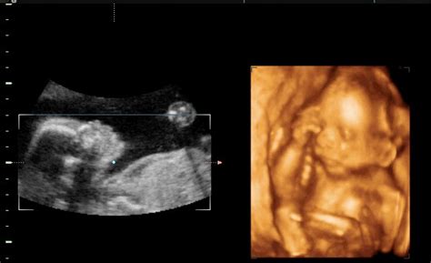 孕8周超声图像看胎儿位置
