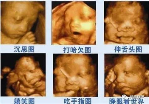 胎儿产前四维超声注意事项