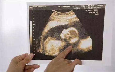 怀孕期间怎么保护胎儿
